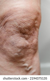 Phlebeurysm, Varicose Veins Of The Lower Extremities Close-up, Peripheral Vascular Disease.