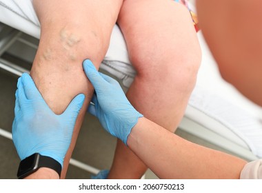 a phlebologist examines a patient with varicose veins on his leg. phlebology - study of venous pathologies of the lower extremities