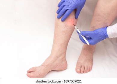 A phlebologist holds a scalpel near the patient's leg of a woman who has varicose veins in her legs. Concept of modern vein removal with phlebectomy, treatment