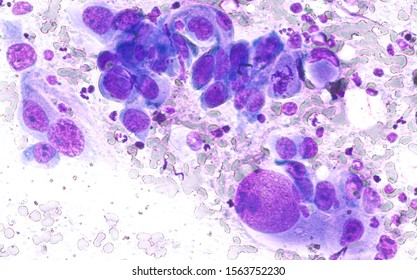 Phogomicrograph Of Fine Needle Aspiration (FNA) Cytology Of A Pulmonary (lung) Nodule Showing Adenocarcinoma, A Type Of Non Small Cell Carcinoma.