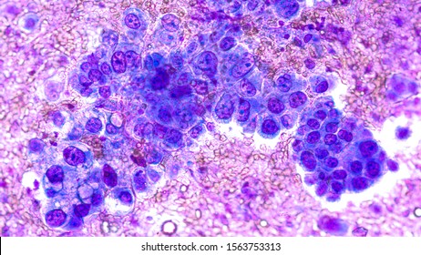 Phogomicrograph Of Fine Needle Aspiration (FNA) Cytology Of A Pulmonary (lung) Nodule Showing Adenocarcinoma, A Type Of Non Small Cell Carcinoma.