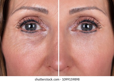 Photo Of Anti-aging Procedures On Caucasian Woman Face