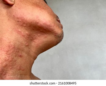 Photo Of An Asian Man With A Skin Rash On His Neck.