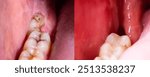 Photo before and after removal of an impacted wisdom tooth. A cavity in the jaw after tooth extraction, Traumatic