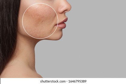 Photo before and after treatment for acne. A young girl with a problem skin. Skin treatments. Cosmetology and professional skin care. - Shutterstock ID 1646795389