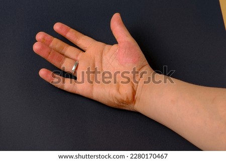 photo of boy hand with cutaneous problem causing peeling of skin
