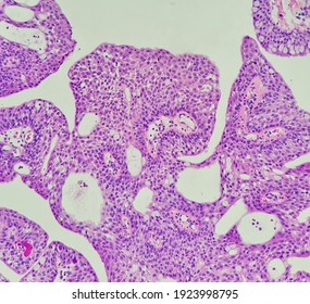 Photo Of Conjunctival Papilloma, Showing Squamous Epithelium With Scattered Goblet Cell, Magnification 200x, Photo Under Microscope