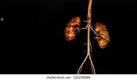 Photo Of  CT Angiogram Shown The Aorta , Kidney And Common Iliac Artery With 3D Reconstruction On Dark Background. Focus On The Kidney