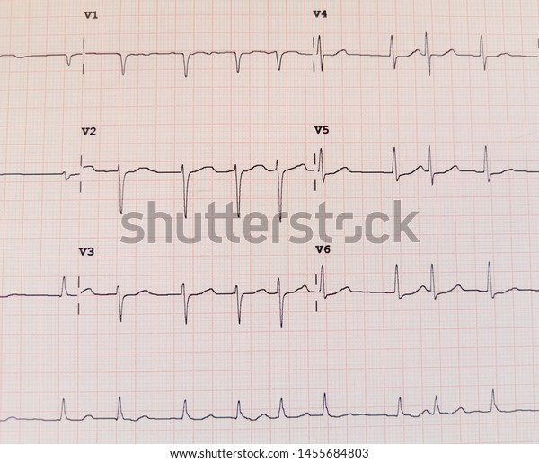 Photo Effects Ecg Type Atrial Fibrillation Stock Photo (Edit Now ...