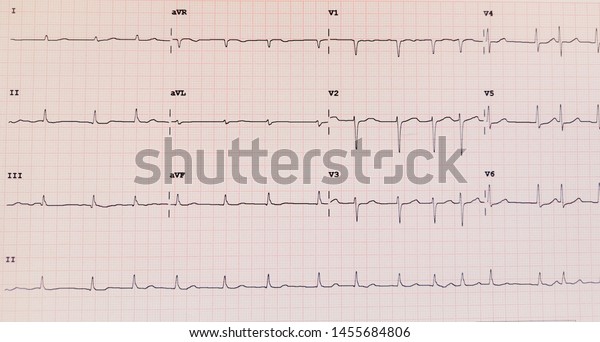 Photo Effects Ecg Type Atrial Fibrillation Stock Photo (Edit Now ...