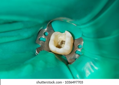 photo endodontic treatment of dental canals in the lower molar permanent tooth molar with endodontic file with apex locator, tooth with clamp attached to it by cofferdam - Shutterstock ID 1036497703