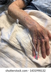 Photo Of Female Patients Bruised Hand And Arm At High Point Memorial Hospital On June 23, 2019 Located In High Point, NC USA