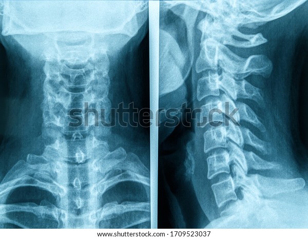 Photo of human neck X-ray
image