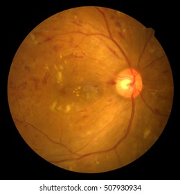Photo Madical Retina Abnormal isolated on black background.Retina of diabetes , diabates retinopathy.