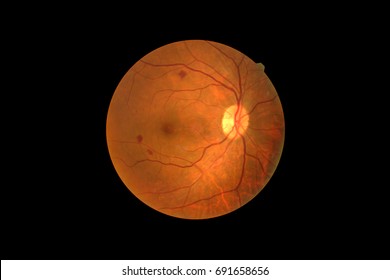 Photo Madical Retina Abnormal Isolated On Black Background.Retina Of Diabetes , Diabates Retinopathy.