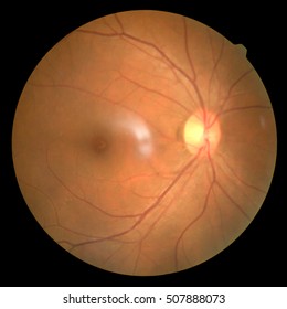 Download 770 Background Retinopathy Paling Keren