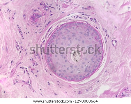 Photo from a microscope of a tissue section of an hair follicle in a Histology slide,testing for alopecia diseases,stained with periodic acid shiff (PAS)showing  blue purple nucleus and pink cytoplasm