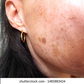 Photo Of Pigmentation Spots On Face