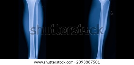 A photo of plain radiograph on dark background in hospital. The film use for diagnosis the illness of patient.Medical concept. A man with fracture tibia bone. A leg fracture.