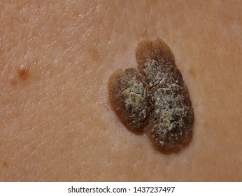 Seborrheic Keratosis 图片 库存照片和矢量图 Shutterstock