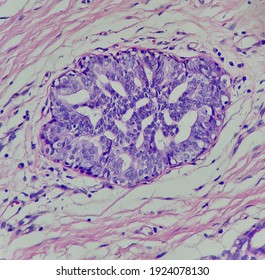 Photo Of Usual Ductal Hyperplasia In Breast Tissue, Magnification 400x, Photo Under Microscope