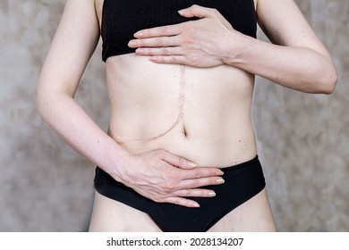 Photo Of A Woman's Body With A Scar After A Liver Transplant Surgery. A Woman Without A Face In Black Lingerie Shows A Scar On Her Abdomen After A Liver Donation.