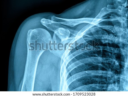 Photo of X-ray film of human shoulder