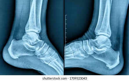 Photo Of X-ray Of Human Heel Spur