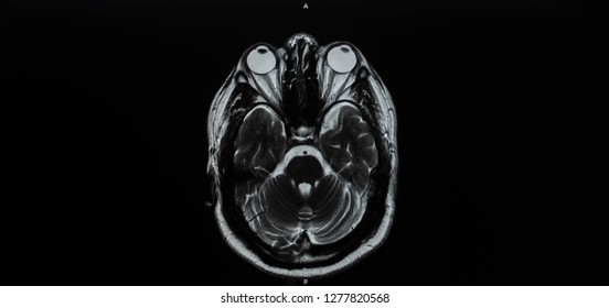 Photograph Of Magnetic Resonance Imaging Of Human Brain In Axial Tomography In The Cut Of Eye , Orbit , Temporal Lobe And Cerebellum . TheMRI Use In Hospital For Diagnosis The Medical Illness. 