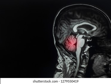 Tumor cerebral severo de migraña