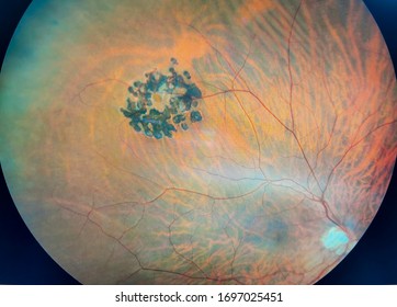 Photograph of Retina showing Laser treatment to Hole in Retina
