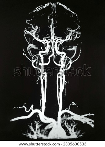 Photographs of the cerebral arteries and veins of a patient undergoing a brain scan