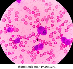 Photomicrograph Of Acute Myeloblastic Leukemia (AML), A Cancer Of White Blood Cell