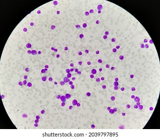 Photomicrograph Of Acute Myeloblastic Leukemia (AML), A Cancer Of White Blood Cell