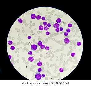 Photomicrograph Of Acute Myeloblastic Leukemia (AML), A Cancer Of White Blood Cell