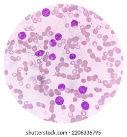 Photomicrograph Of Acute Myeloblastic Leukemia (AML), A Cancer Of White Blood Cell