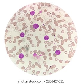 Photomicrograph Of Acute Myeloblastic Leukemia (AML), A Cancer Of White Blood Cell