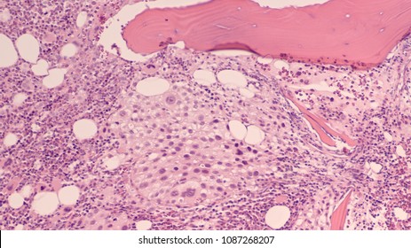 Photomicrograph of a bone marrow biopsy showing involvement by metastatic malignant melanoma, a type of skin cancer that has a propensity for metastasis.  