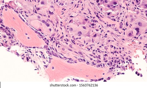 Photomicrograph Of A Bone Marrow Biopsy Showing Involvement By Metastatic Pulmonary Adenocarcinoma (lung Cancer), A Type Of Non Small Cell Carcinoma.  