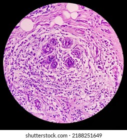 Photomicrograph of breast abscess, Granulomatous mastitis, show dense infiltration of polymorphs,lymphocytes, histiocyte,epithelioid cells,plasma cells,fibroblast.