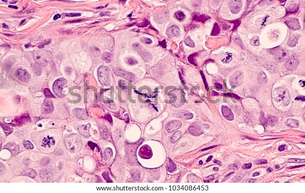 grade 3 cancer cells breast