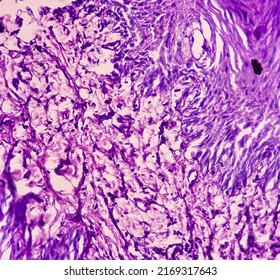 Photomicrograph of chronic osteomyelitis from maxillary region tissue, image show bony tissue, dead bone, polymorphs, lymphocytes, histiocytes.