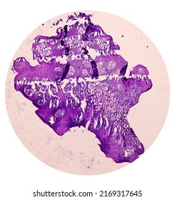 Photomicrograph of chronic osteomyelitis from maxillary region tissue, image show bony tissue, dead bone, polymorphs, lymphocytes, histiocytes.