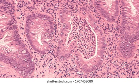 Photomicrograph of a colon biopsy obtained during colonoscopy showing ulcerative colitis, a type of inflammatory bowel disease (IBD).  Branched crypts with cryptitis and crypt abscesses are seen. 