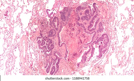 Photomicrograph of colonic adenocarcinoma, metastatic to lung.  Normal lung tissue can be seen surrounding the tumor deposit in this patient with a prior history of colon cancer.  