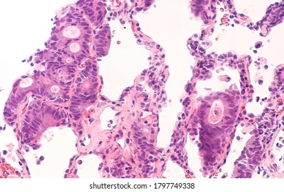Photomicrograph of colonic adenocarcinoma, metastatic to lung.  Normal lung tissue can be seen surrounding the tumor deposit in this patient with a prior history of colon cancer.  