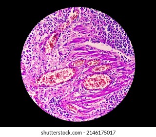 Photomicrograph Of A Cross Section Of An Appendix In A Child With Acute Appendicitis.