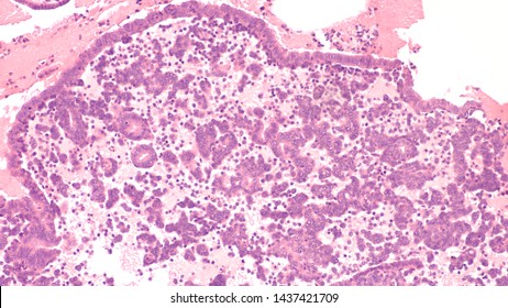 Photomicrograph Of An Endometrial Biopsy In A Woman With Abnormal Vaginal Bleeding (dysfunctional Uterine Bleeding) Showing Glandular And Stromal Breakdown.  