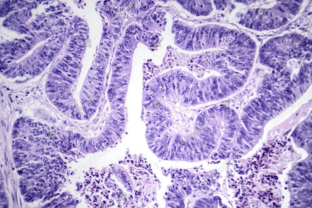 Photomicrograph of esophageal squamous cell carcinoma, showing ...