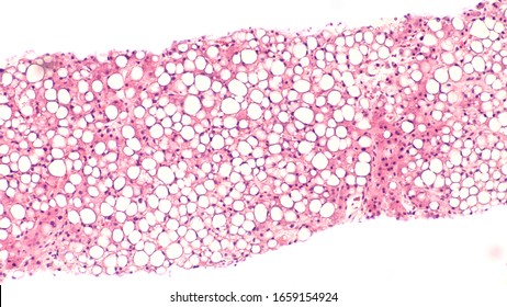 Photomicrograph Of Liver Biopsy Histology (pathology) Showing Steatosis (